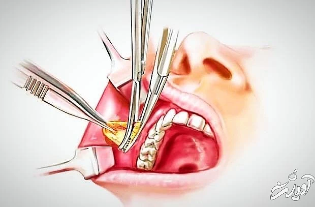 بیچکتومی چیست